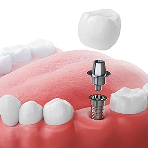 Single dental implant replacing missing tooth in New Baltimore