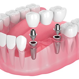 Graphic showing implant bridge restoration in New Baltimore