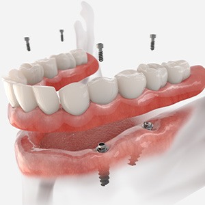 Graphic showing implant dentures in New Baltimore