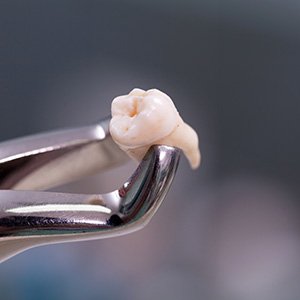 Preliminary treatment like tooth extractions will add to the cost of your dental implant treatment