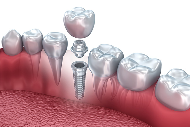 Right Image - 0-Dental Implants