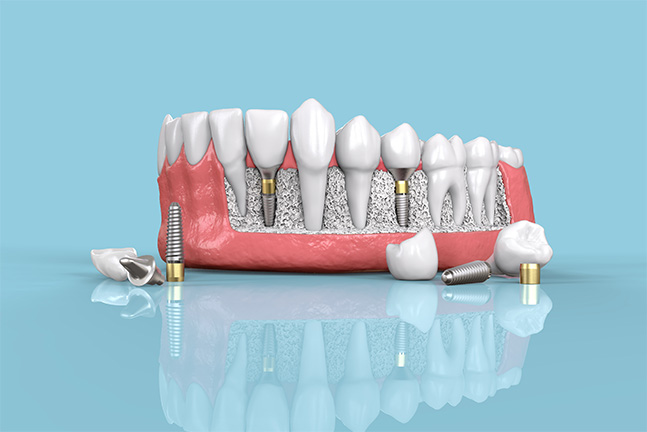 Right Image - 1-Dental Implants