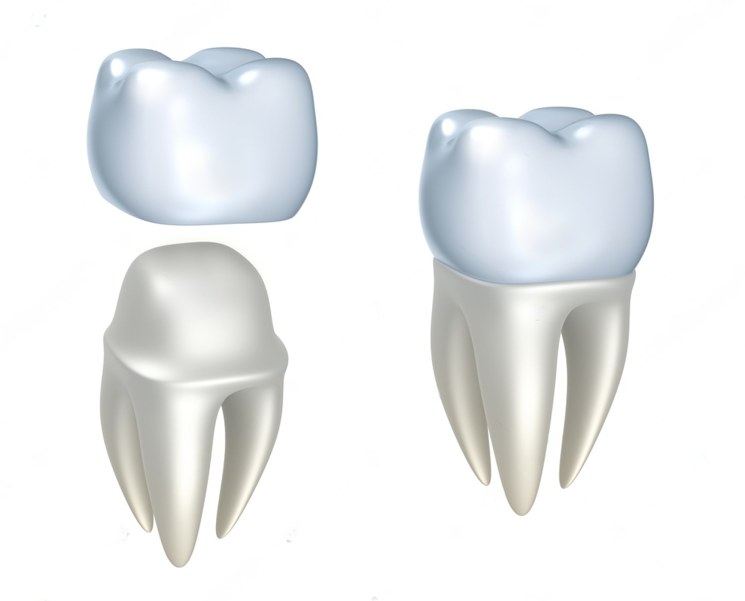 Left Image - 1-Dental Crowns & Bridges